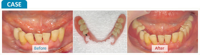バルプラスト義歯の症例
