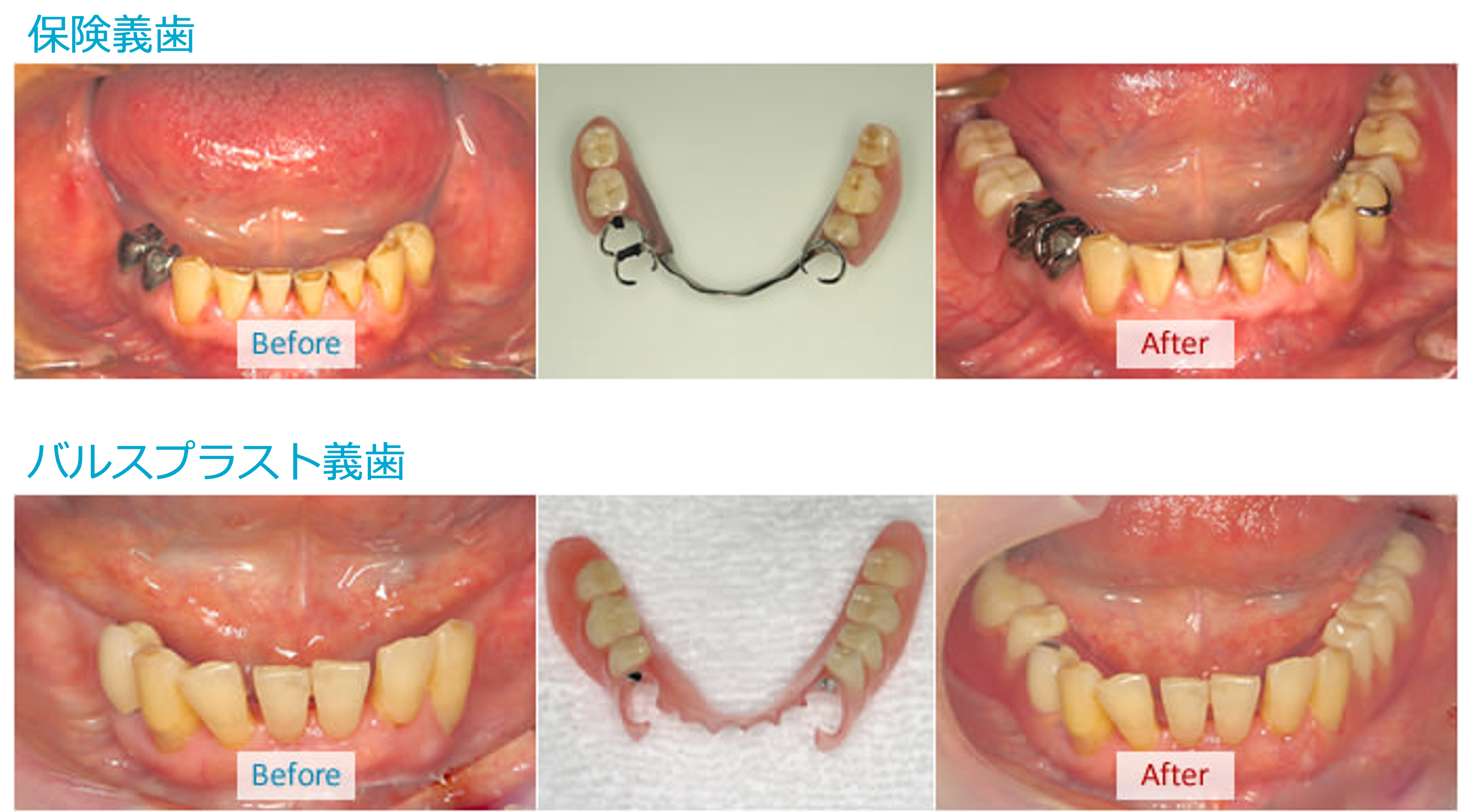 保険義歯とバルプラスト義歯の比較