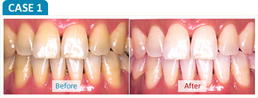 ホームホワイトニングの治療 症例1