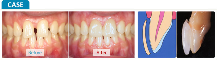 オールセラミックベニア 症例