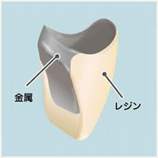 前装冠