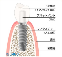 インプラント構造イメージ