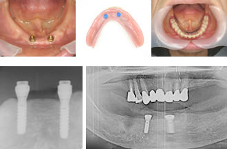 総入れ歯（保険治療も可）