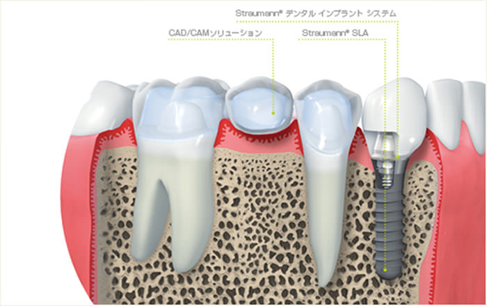 インプラントイメージ