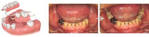 部分入れ歯（大）(保険治療も可)