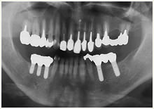 インプラントレントゲン画像