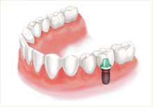インプラントイメージ
