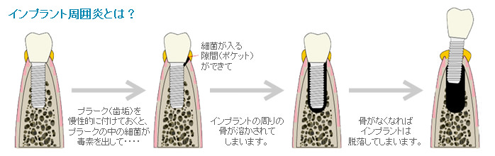 インプラント周囲炎とは？