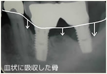 皿状に吸収した骨