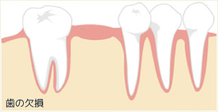 歯の欠損