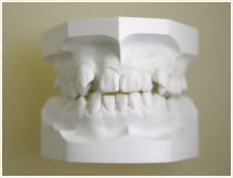 歯型模型