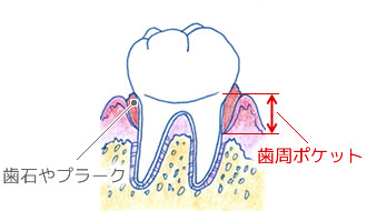 歯周病が進んだ状態