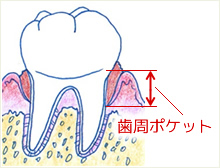 歯周ポケット